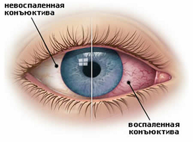 конъюнктивит это
